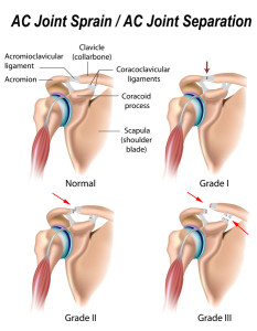 AC-Joint-Separation