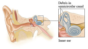 BPPV